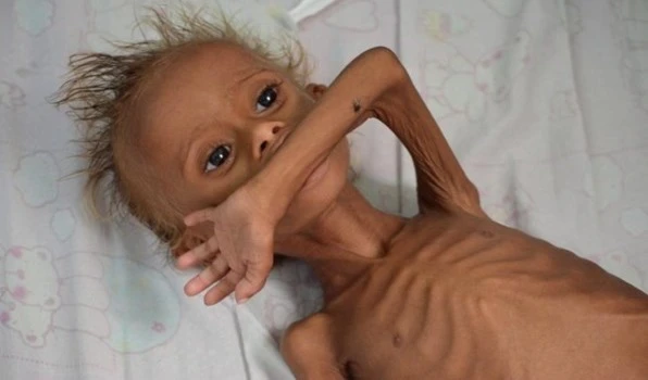 Ministro de Salud: Más de cinco millones de yemenitas sufren de desnutrición debido a la agresión.