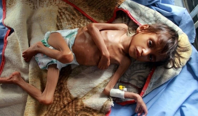 ONU: miles de yemenitas mueren de hambre. ONU: miles de yemenitas mueren de hambre.