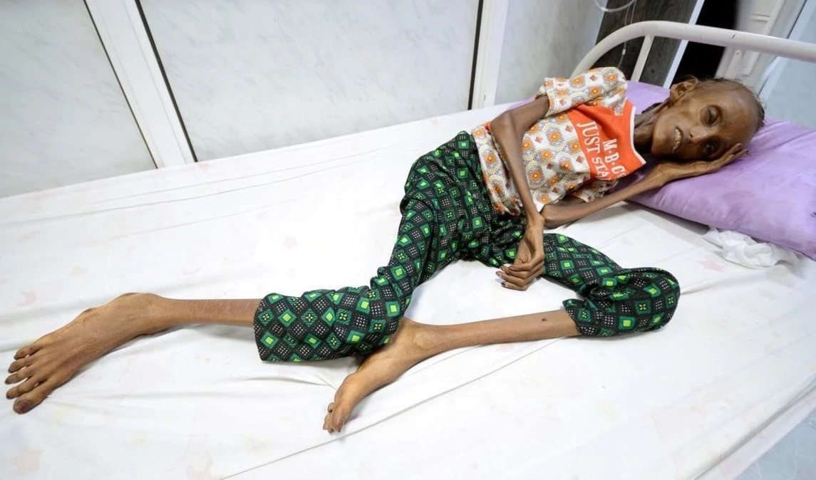 ONU advierte sobre deterioro alarmante de la situación humanitaria en Yemen. 