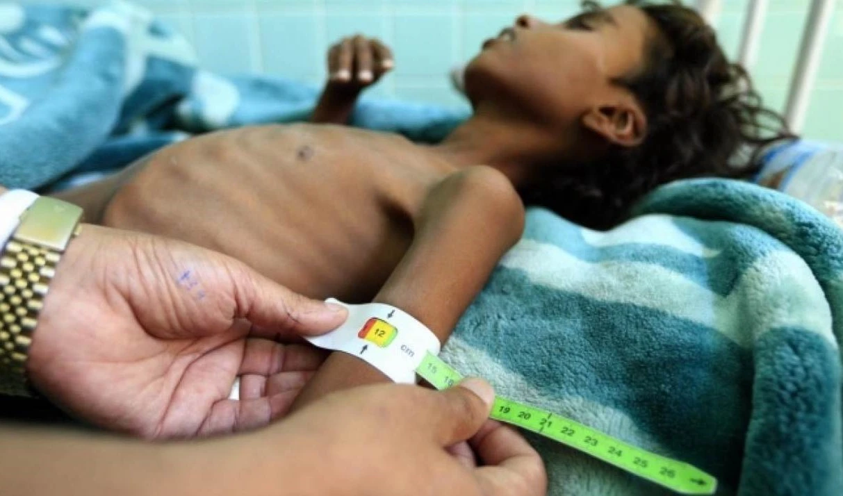 Alrededor de 300 niños yemenitas mueren todos los días por desnutrición.