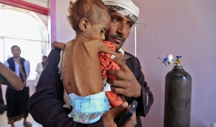 El Fondo de las Naciones Unidas para la Infancia (UNICEF) estimó un aumento en el número de niños que sufrirán desnutrición aguda en 2021 en Yemen. El Fondo de las Naciones Unidas para la Infancia (UNICEF) estimó un aumento en el número de niños que sufrirán desnutrición aguda en 2021 en Yemen.