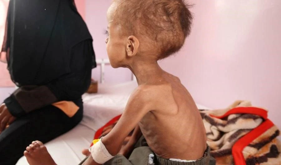 El 75% de los niños yemenitas están crónicamente desnutridos, advierte OMS.