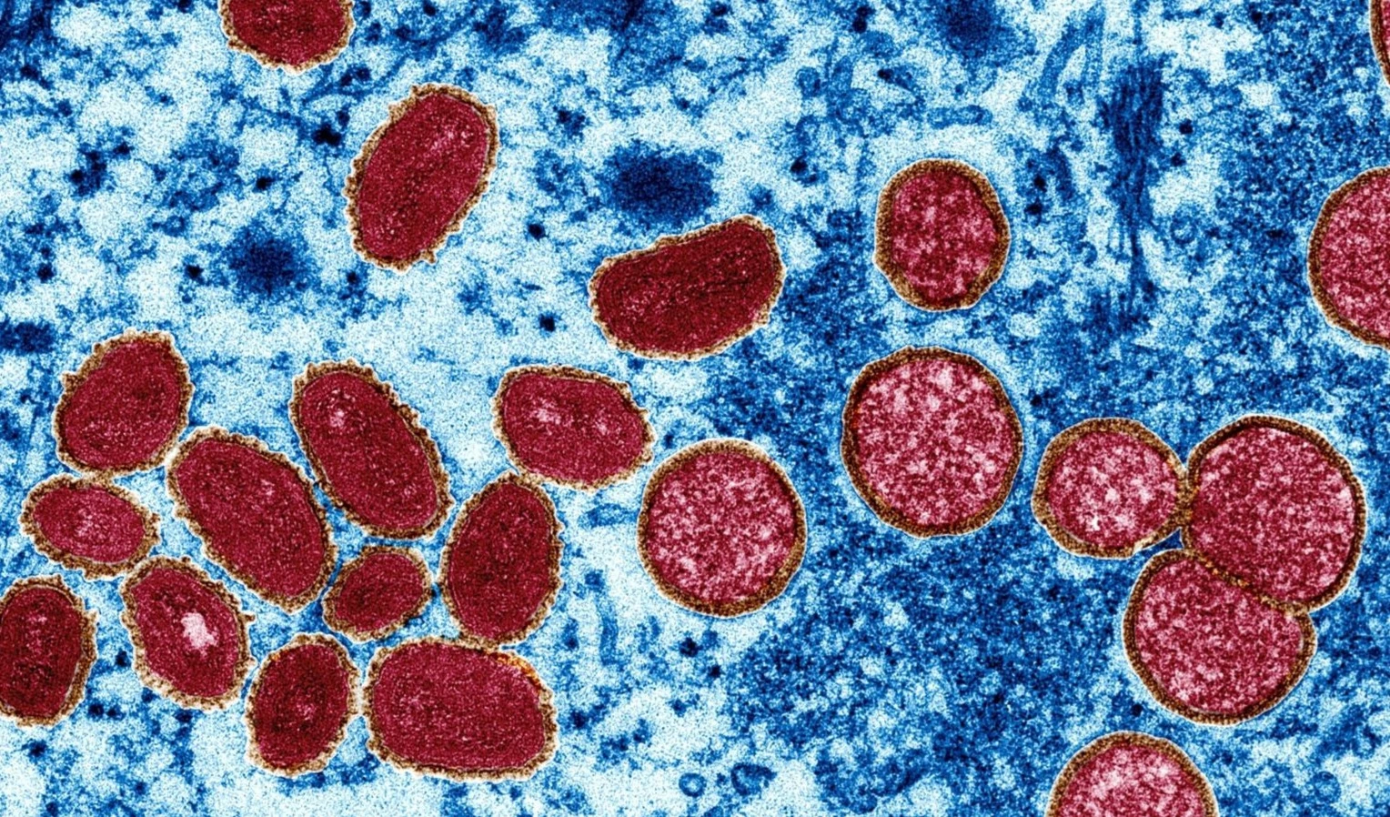 Chile confirma segunda muerte por viruela símica