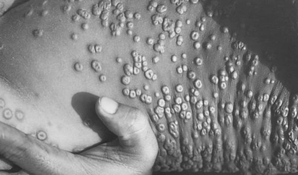 Debemos contener la viruela del mono antes de que sea una amenaza