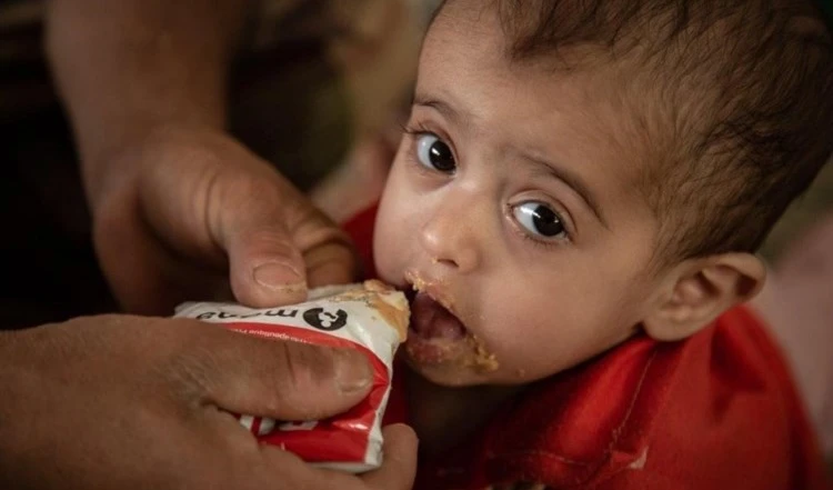 El 75 por ciento de los niños yemenitas están crónicamente desnutridos.