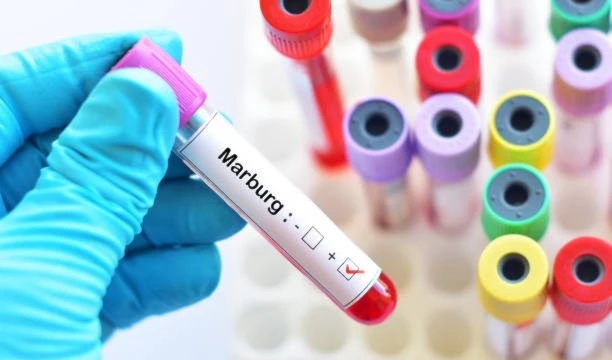 Tanzania confirma su primer brote del virus de Marburgo. Foto: Istock. Tanzania confirma su primer brote del virus de Marburgo. Foto: Istock.