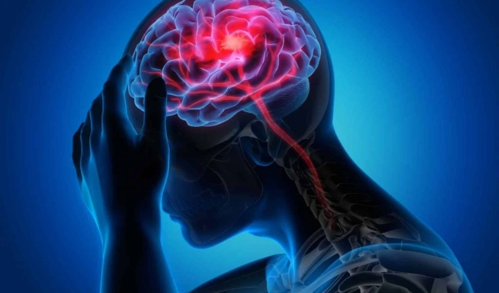 Ejercicios intensos pueden inducir accidentes cerebrovasculares. Foto: Shutterstock.