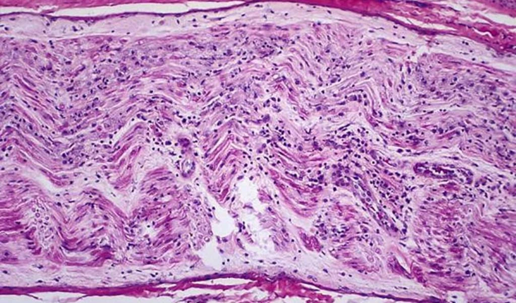 Perú declara emergencia sanitaria por síndrome de Guillain Barré