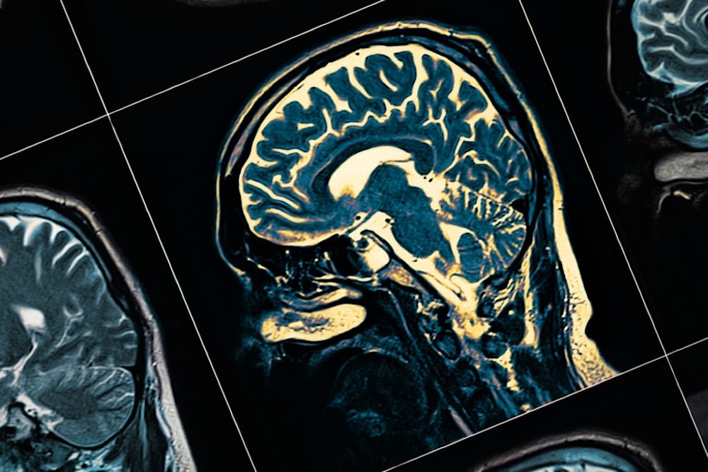 Identifican el origen de un tipo inusual de epilepsia