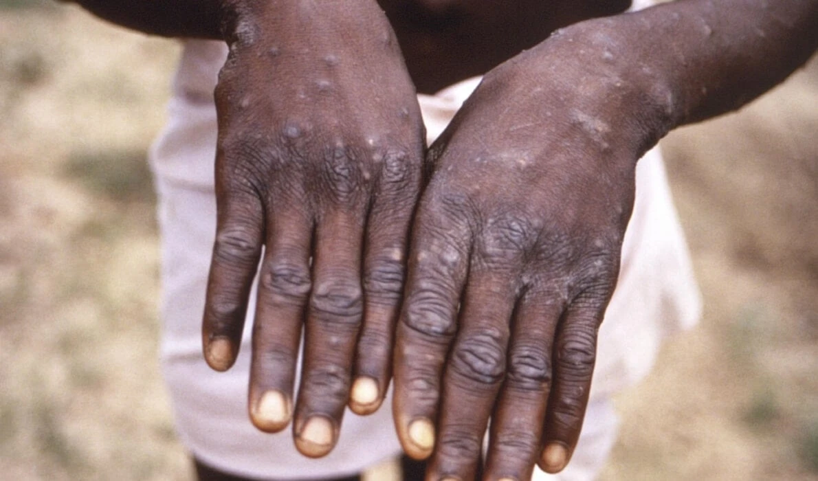 La OMS convoca una reunión de emergencia sobre el mpox