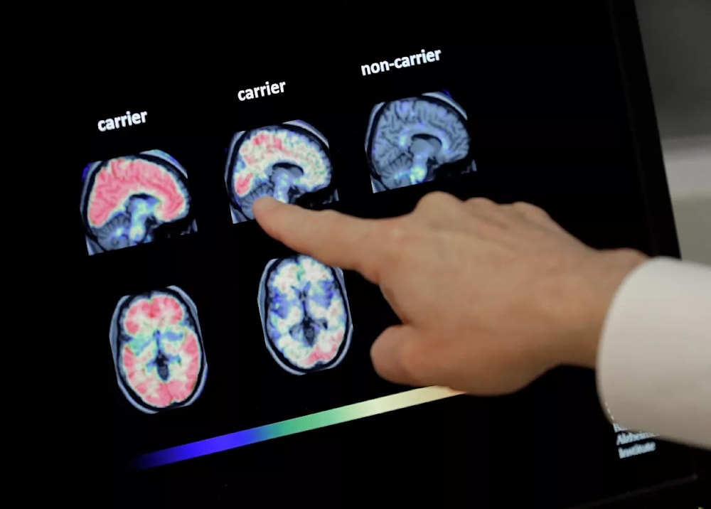 Vinculan tratamiento médico obsoleto con transmisión de alzhéimer