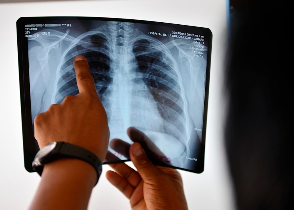 Secuelas pulmonares empeoran dos años después de la Covid-19