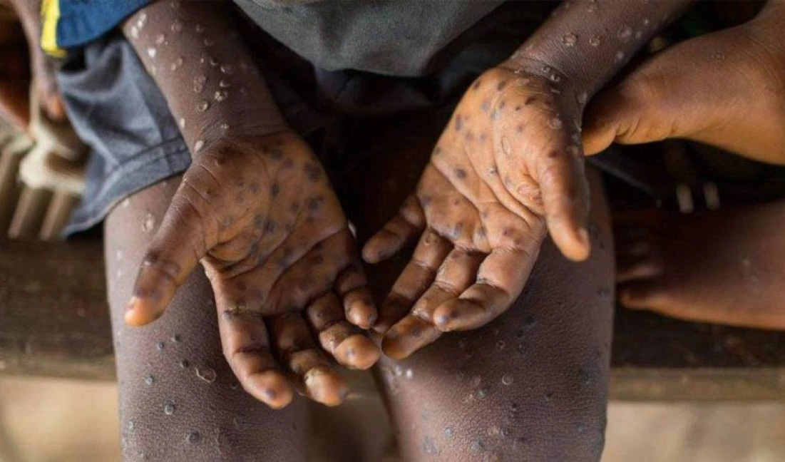 Lo que se sabe sobre la emergencia sanitaria mundial de MPOX