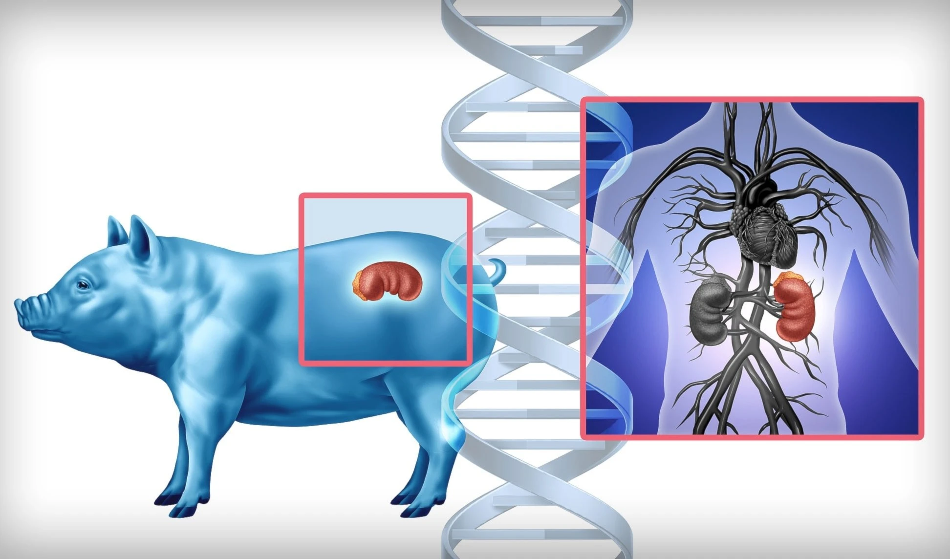 Trasplantan riñón de cerdo a paciente con insuficiencia renal crónica Trasplantan riñón de cerdo a paciente con insuficiencia renal crónica