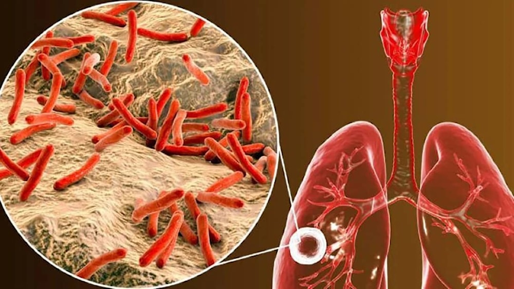 ¿Por qué la tuberculosis, evitable y curable, aún es una crisis?