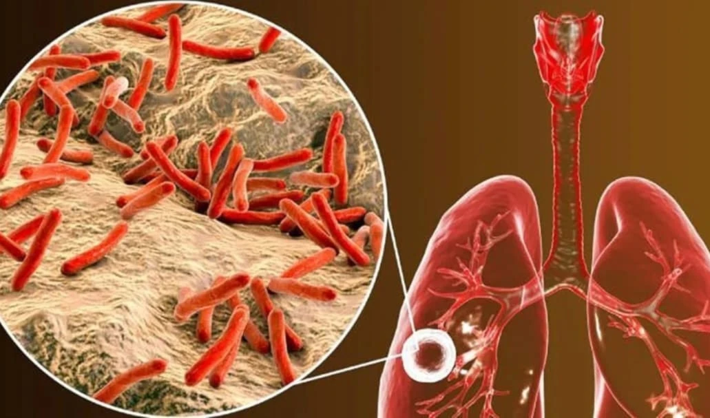 ¿Por qué la tuberculosis, evitable y curable, aún es una crisis?