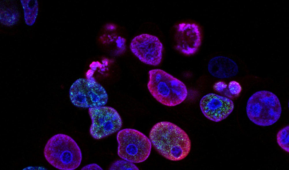 El ejercicio ayuda a pacientes con cáncer de colon a vivir más