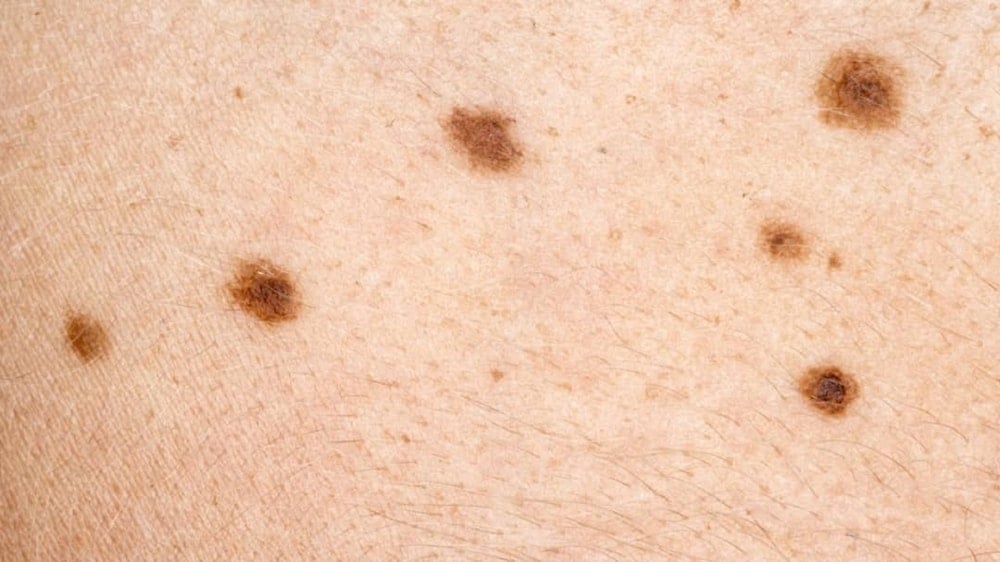 ¿Cómo prevenir el cáncer de piel?