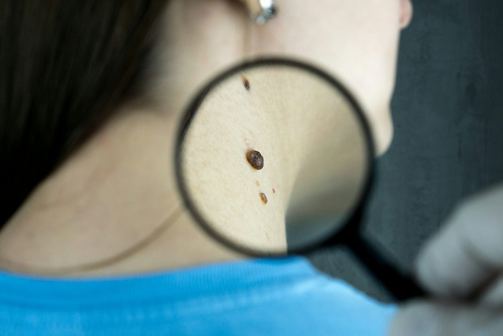 ¿Cómo prevenir el cáncer de piel?