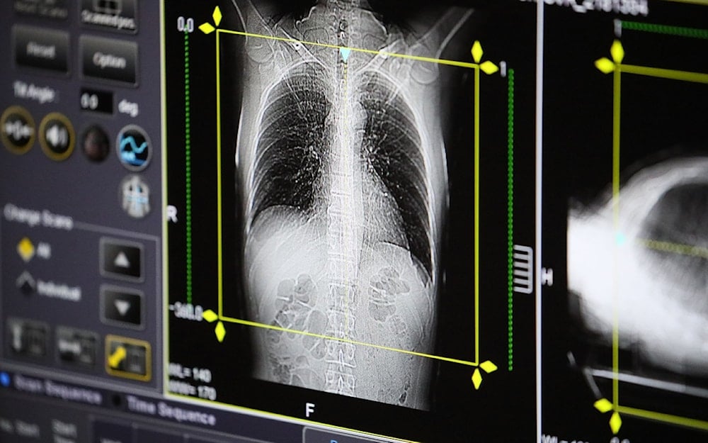 Autopsia de pulmones. Foto: Zumapress