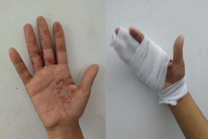 Las manos de Marwas cuentan la historia de la medicina de Gaza, sin detergentes seguros, sin alivio.