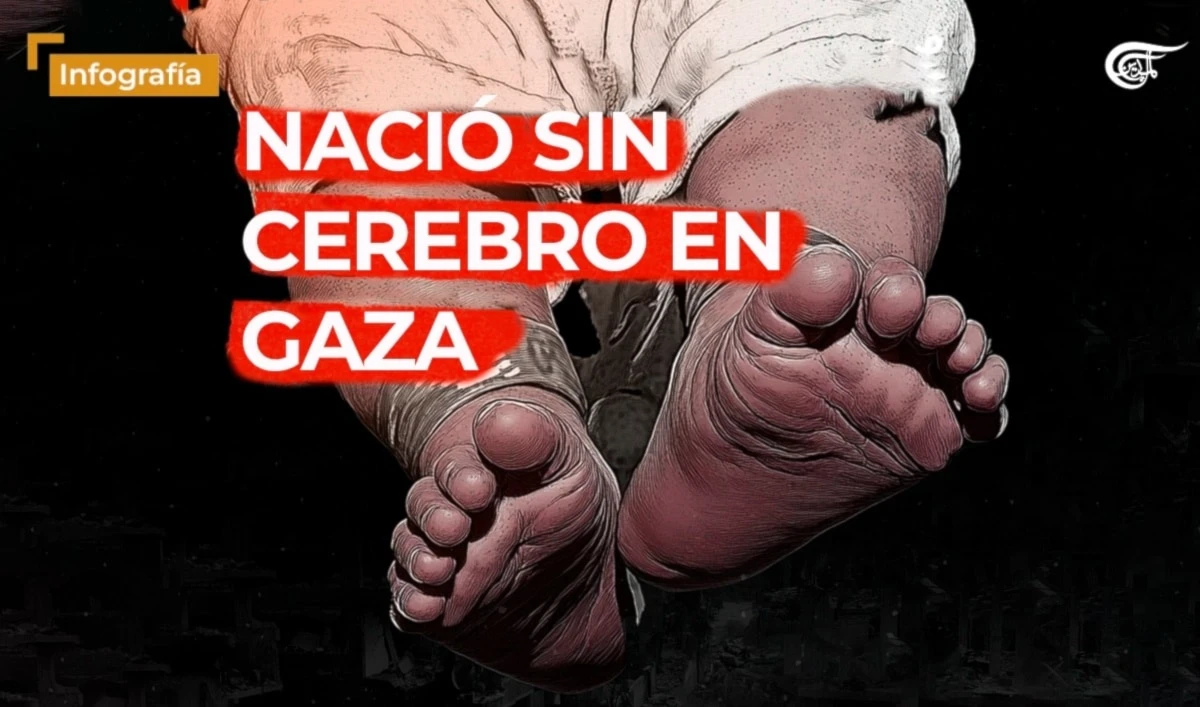 Nació sin cerebro en Gaza