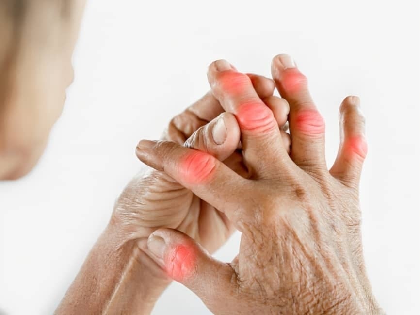 Cerca de 18 millones de personas sufren artritis reumatoide