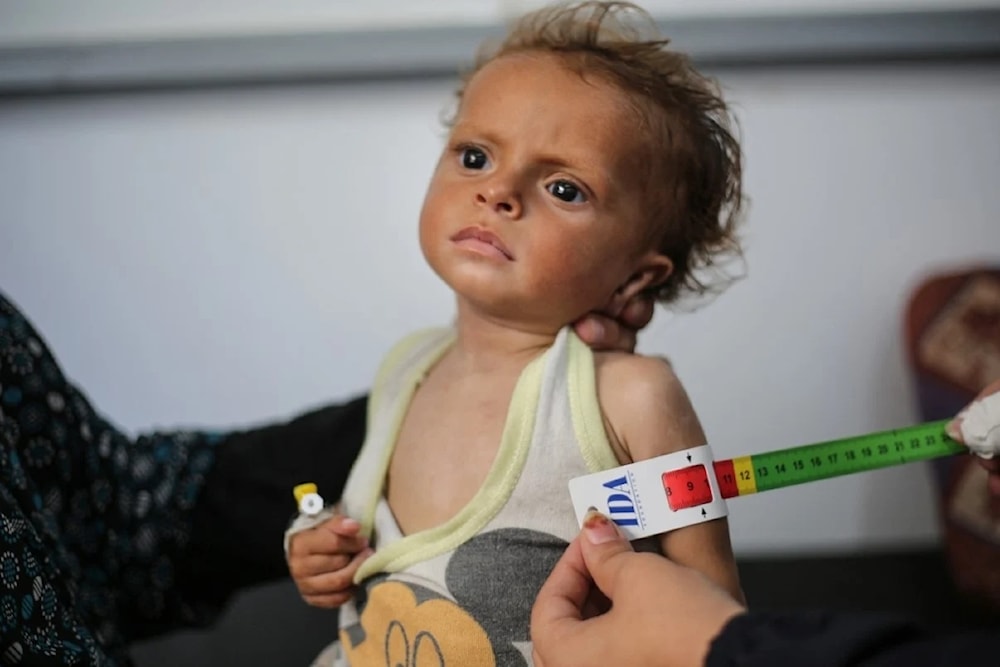 Niño palestino sufre desnutrición debido a la continua agresión y el asedio israelí a la Franja de Gaza. Foto: AFP