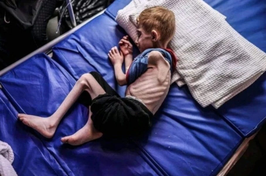 Gaza se queda sin alimentos  para salvar a niños desnutridos