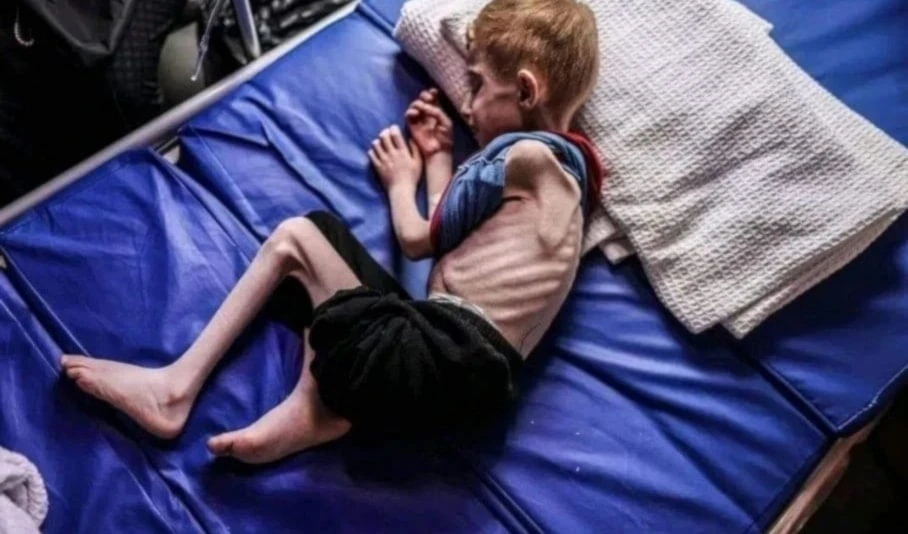 Gaza se queda sin alimentos  para salvar a niños desnutridos Gaza se queda sin alimentos  para salvar a niños desnutridos