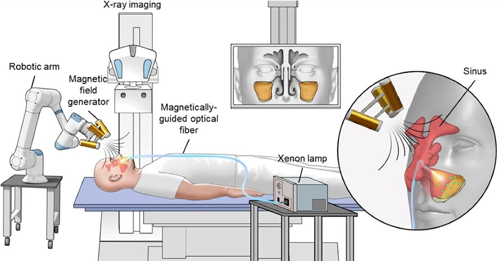 Microrrobots guiados por luz combaten infecciones sinusales profundas