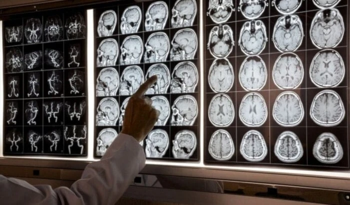 Científicos relacionan síndrome metabólico y enfermedad de Parkinson